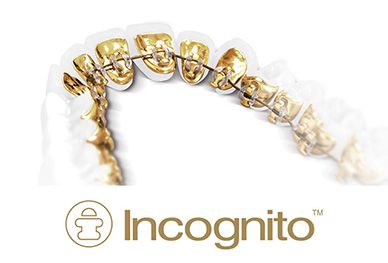 Incognito Lingual Braces HD Orthodontics Long Beach, CA