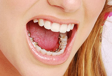 Lingual Braces (Inside Braces), Ortho, Orthodontics