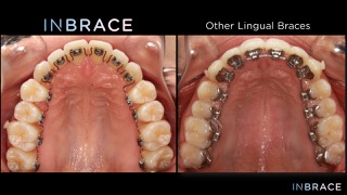 INBRACE Lingual Braces Explained