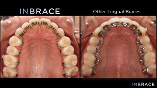 INBRACE Vs Traditional Lingual Braces