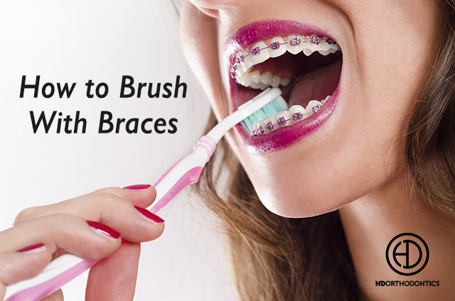 How to brush with braces