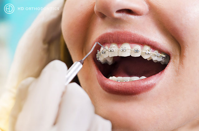 Which Type of Orthodontic Treatment is the Most Discreet?