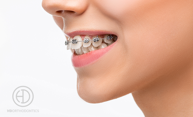 Are There Benefits to Self-Ligating Braces?
