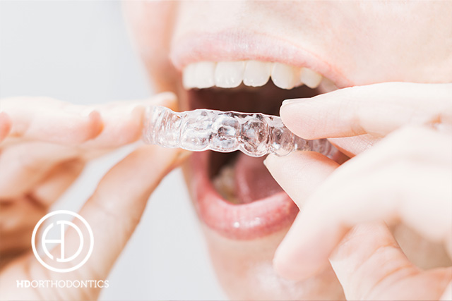 Can Invisalign Work if I’m Missing Teeth?