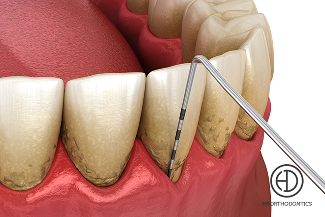 Will Periodontal Disease Affect My Orthodontic Outcome?