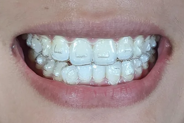 Invisalign Mississauga