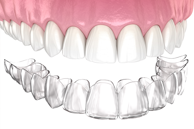 If Your Invisalign Treatment Isn t Working It May Be One Of These Reasons