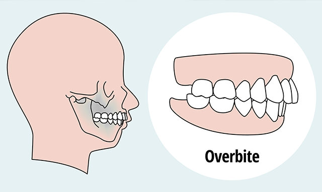 What Is an Overbite and How Can Braces Help?