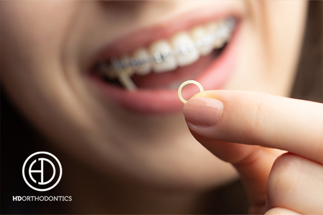Elastics for Braces - Everything You Need to Know - Magic Smiles