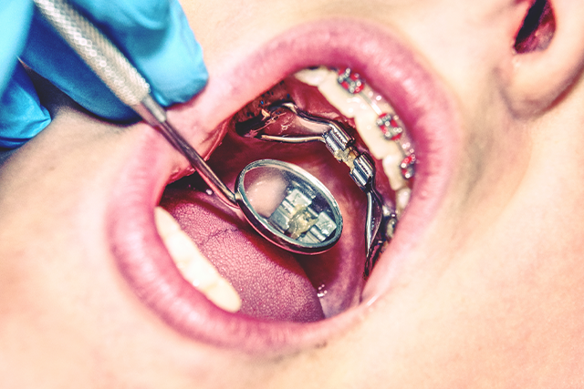 Can You Get a Palatal Expander and Braces at the Same Time?