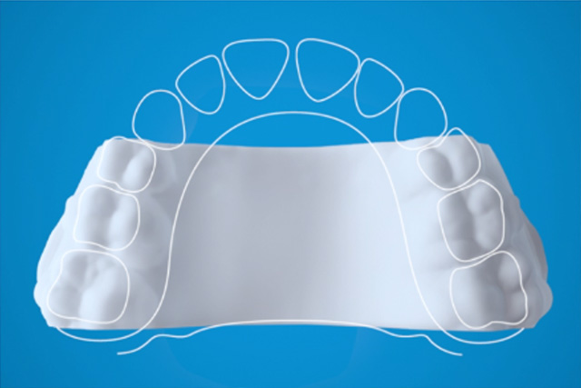 What is the Invisalign Palatal Expander?